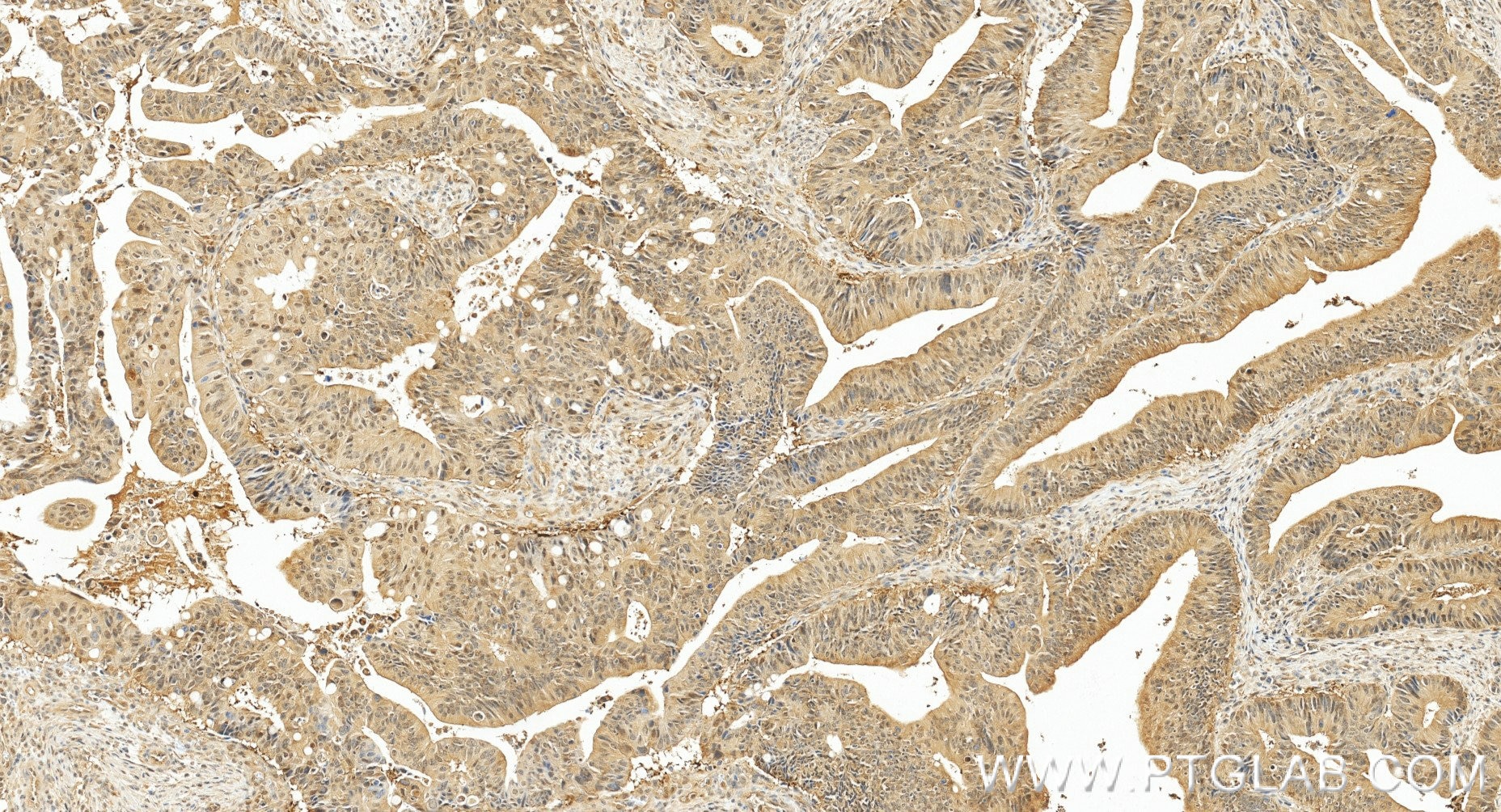 Immunohistochemistry (IHC) staining of human colon cancer tissue using PSMD10/Gankyrin Recombinant monoclonal antibody (86120-2-RR)