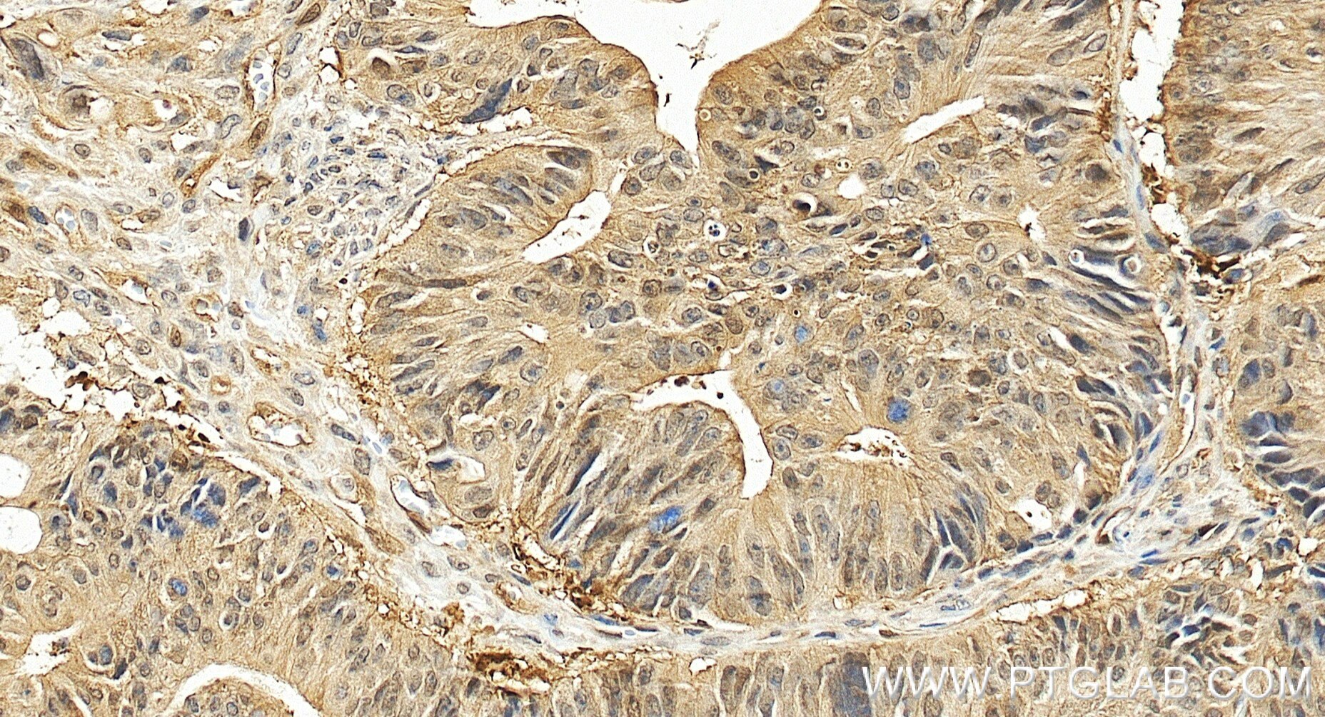 Immunohistochemistry (IHC) staining of human colon cancer tissue using PSMD10/Gankyrin Recombinant monoclonal antibody (86120-2-RR)