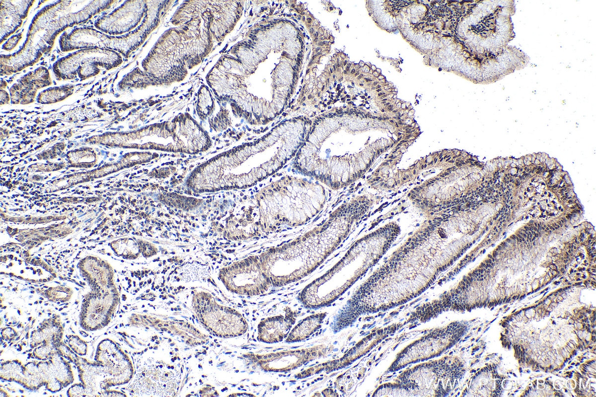 Immunohistochemistry (IHC) staining of human stomach cancer tissue using PSMD11 Polyclonal antibody (14786-1-AP)