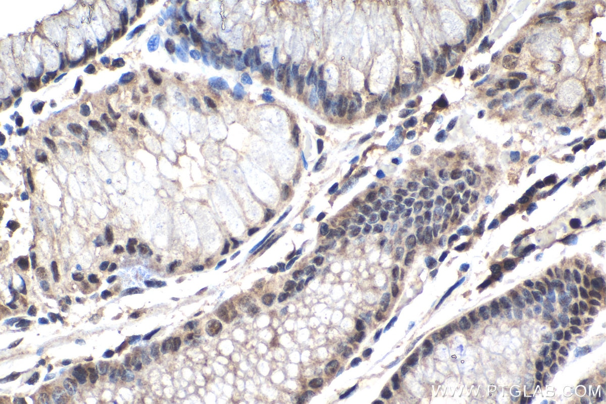 Immunohistochemistry (IHC) staining of human stomach cancer tissue using PSMD11 Polyclonal antibody (14786-1-AP)