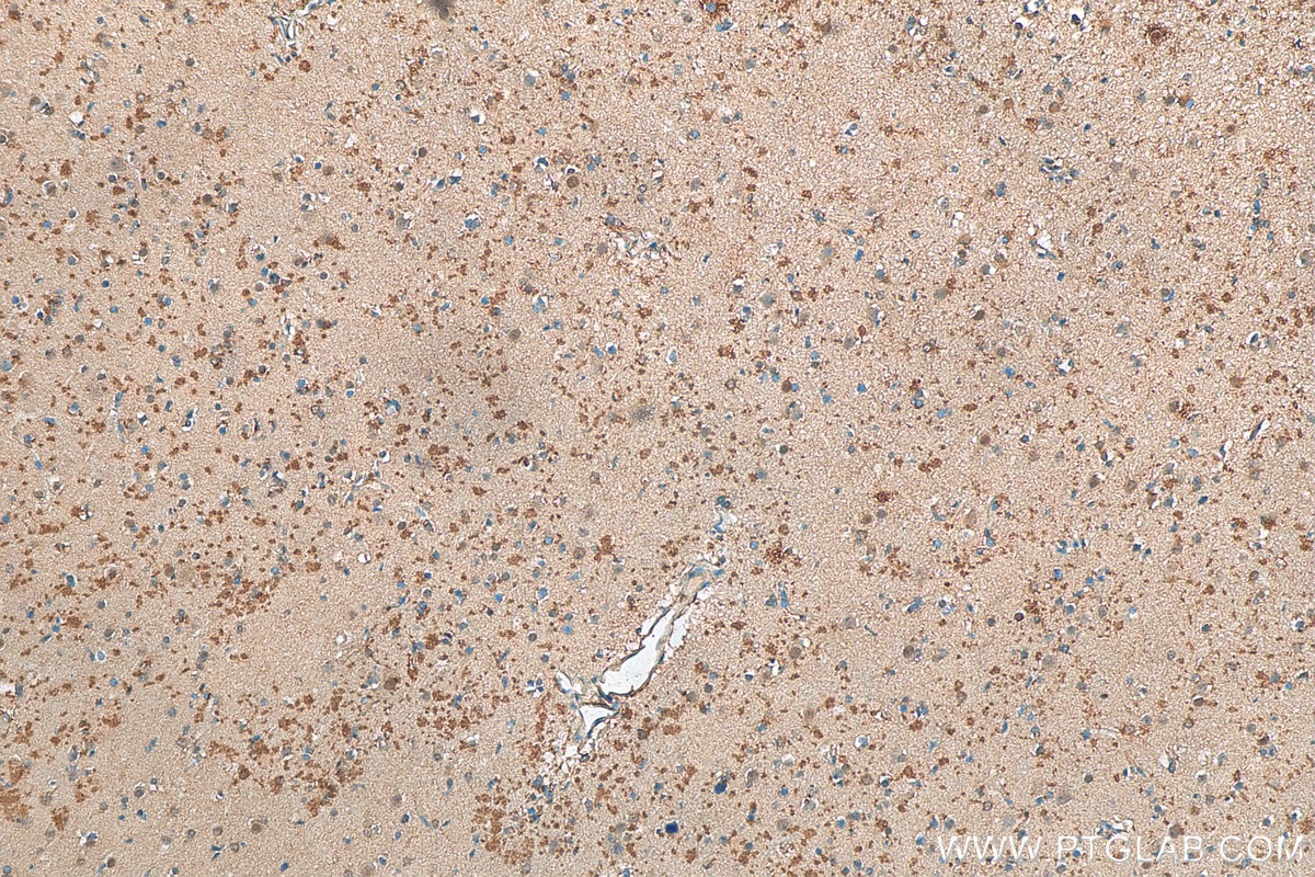 Immunohistochemistry (IHC) staining of human gliomas tissue using PSMD12 Polyclonal antibody (11412-1-AP)