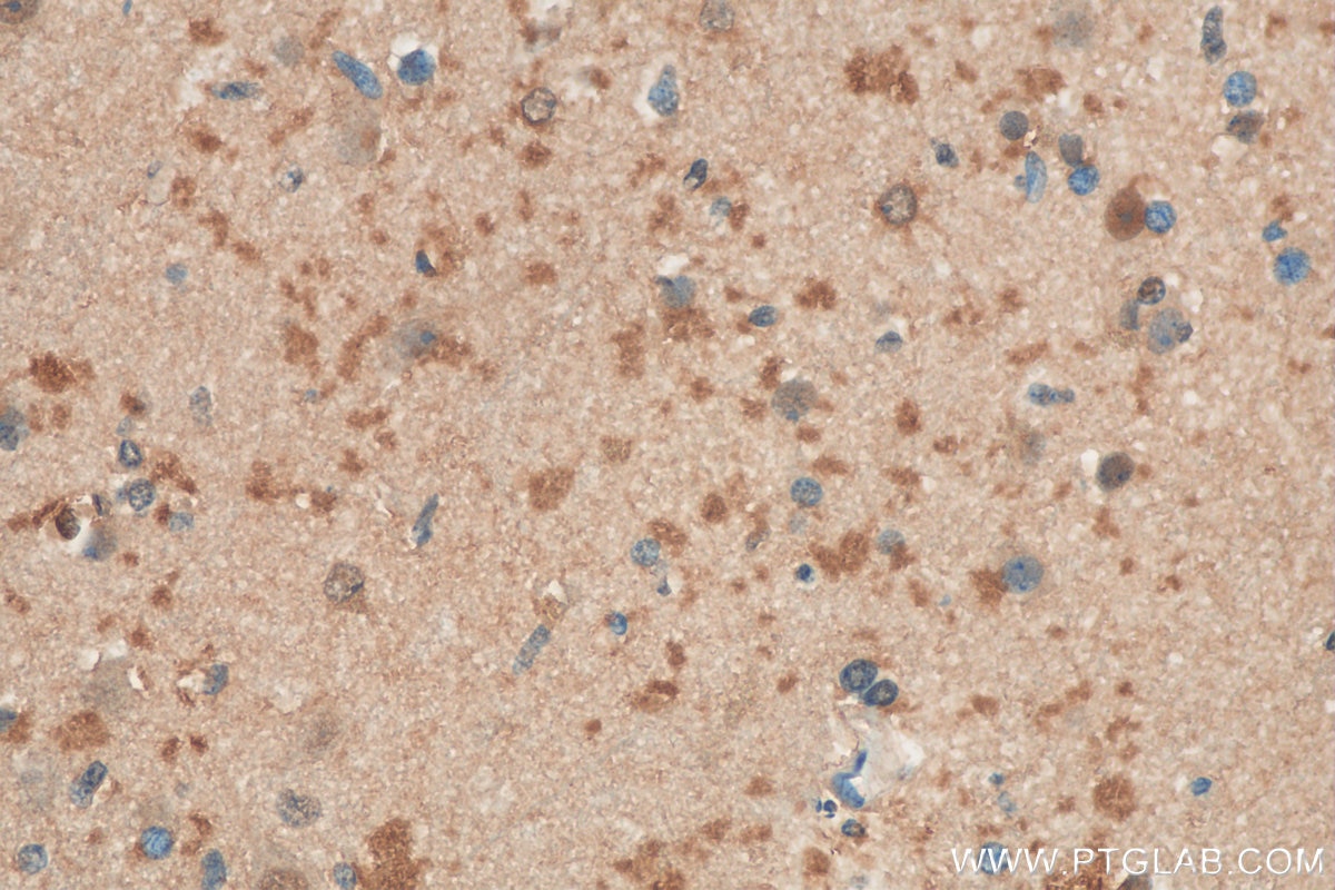 Immunohistochemistry (IHC) staining of human gliomas tissue using PSMD12 Polyclonal antibody (11412-1-AP)