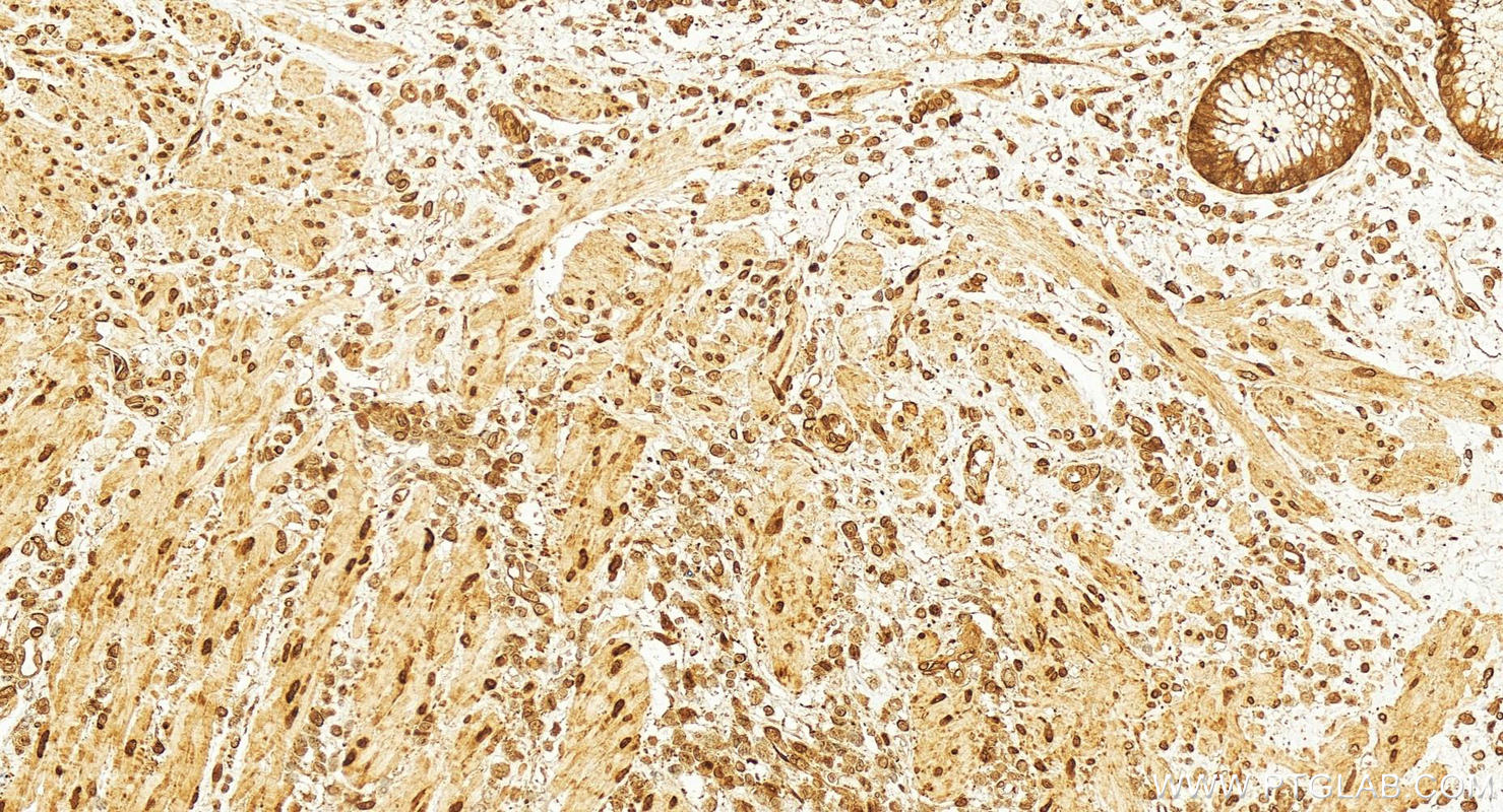 Immunohistochemistry (IHC) staining of human colon cancer tissue using PSMD13 Polyclonal antibody (15261-1-AP)