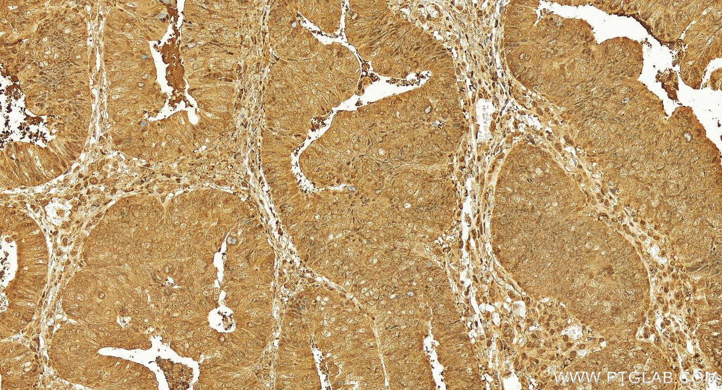 Immunohistochemistry (IHC) staining of human colon cancer tissue using PSMD13 Polyclonal antibody (15261-1-AP)