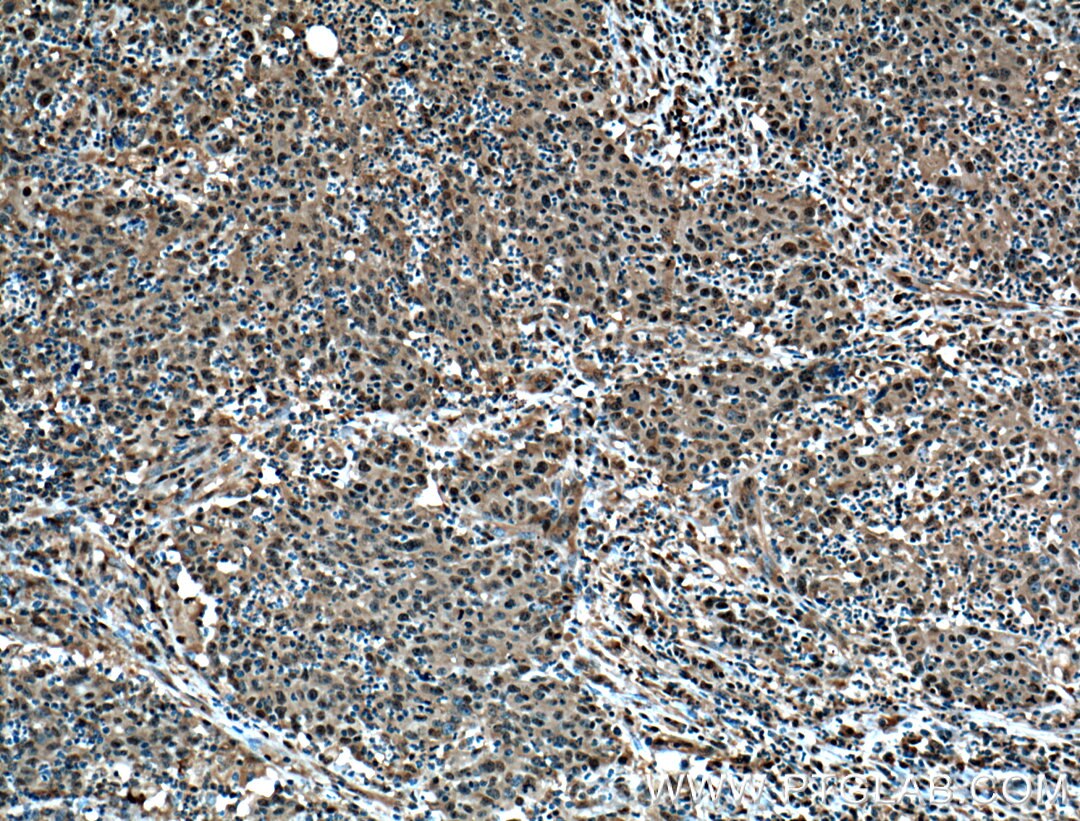 Immunohistochemistry (IHC) staining of human colon cancer tissue using PSMD13 Polyclonal antibody (15261-1-AP)