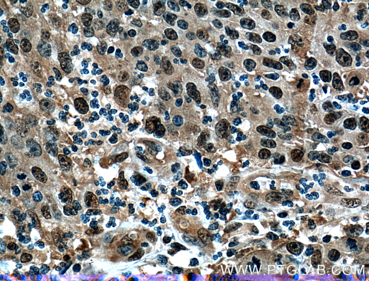 Immunohistochemistry (IHC) staining of human colon cancer tissue using PSMD13 Polyclonal antibody (15261-1-AP)