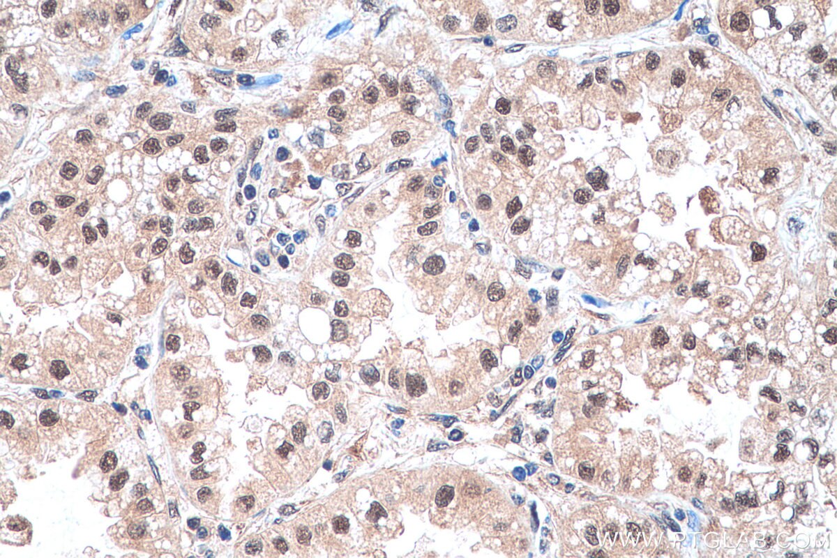 Immunohistochemistry (IHC) staining of human lung cancer tissue using PSMD13 Monoclonal antibody (67807-1-Ig)