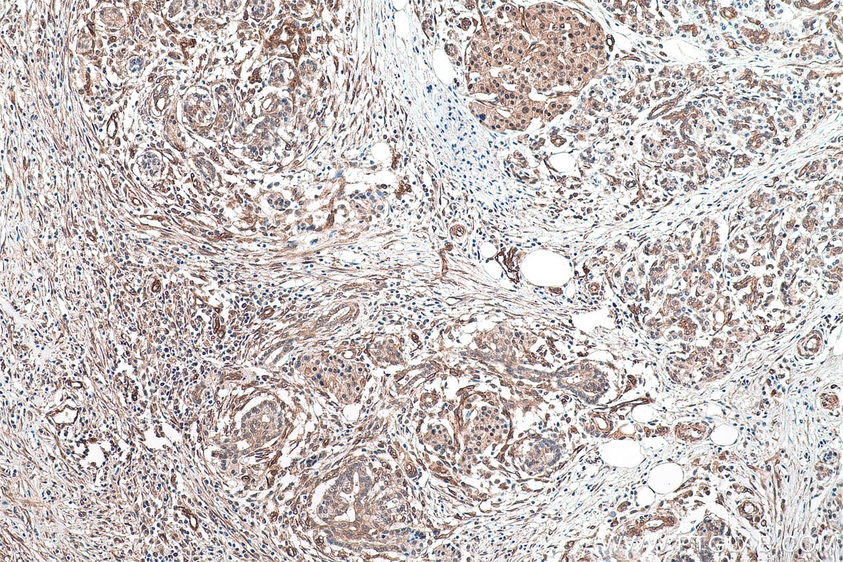 Immunohistochemistry (IHC) staining of human pancreas cancer tissue using PSMD13 Monoclonal antibody (67807-1-Ig)