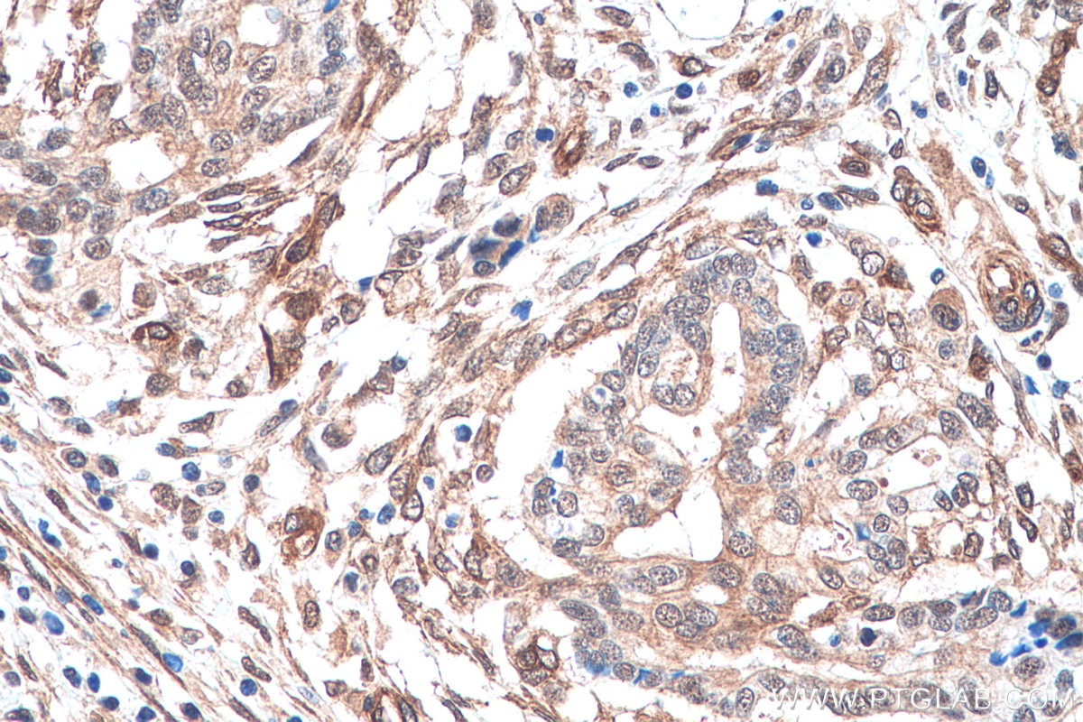 Immunohistochemistry (IHC) staining of human pancreas cancer tissue using PSMD13 Monoclonal antibody (67807-1-Ig)