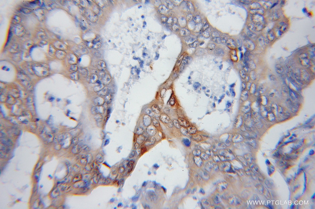 Immunohistochemistry (IHC) staining of human colon cancer tissue using PSMD14/POH1 Polyclonal antibody (12059-1-AP)