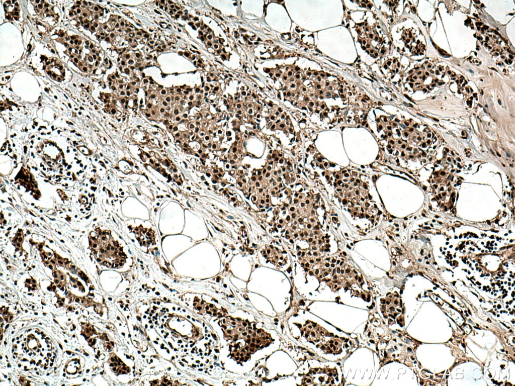 Immunohistochemistry (IHC) staining of human breast cancer tissue using PSMD2 Polyclonal antibody (14748-1-AP)