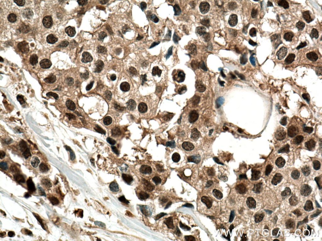 Immunohistochemistry (IHC) staining of human breast cancer tissue using PSMD2 Polyclonal antibody (14748-1-AP)
