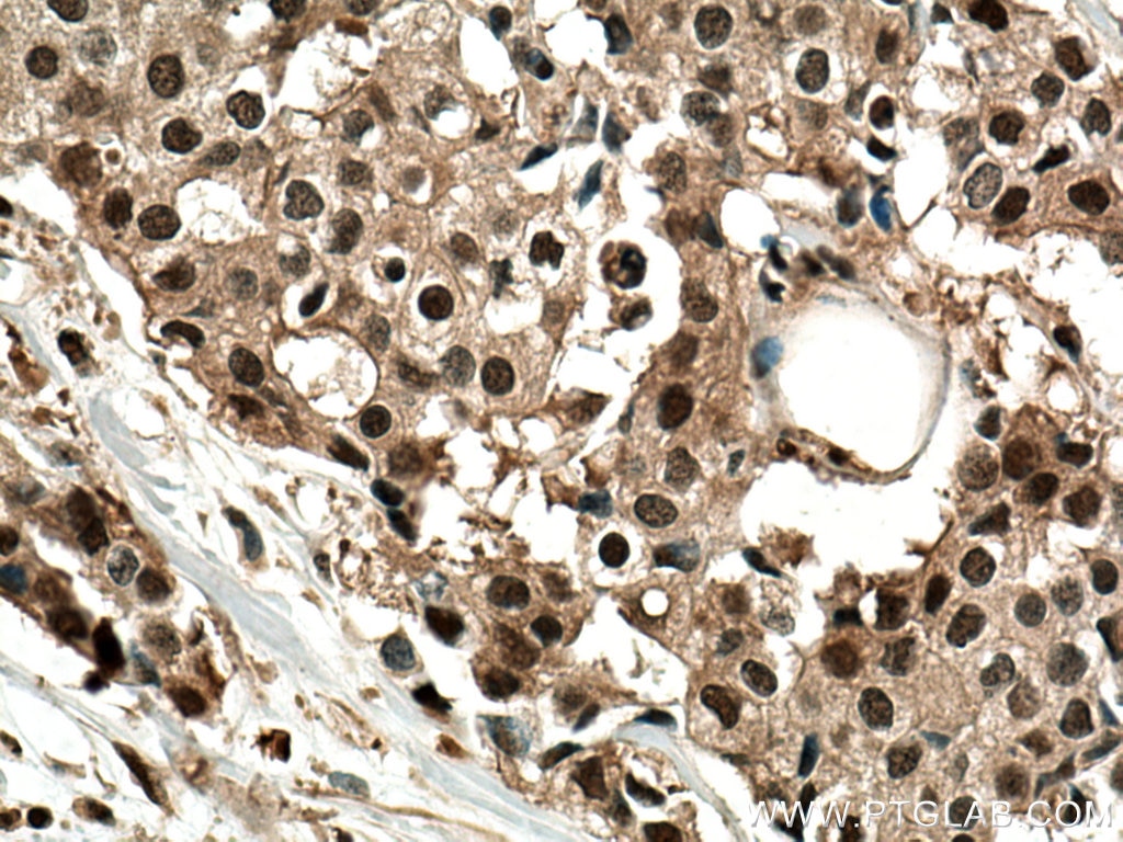 IHC staining of human breast cancer using 14748-1-AP