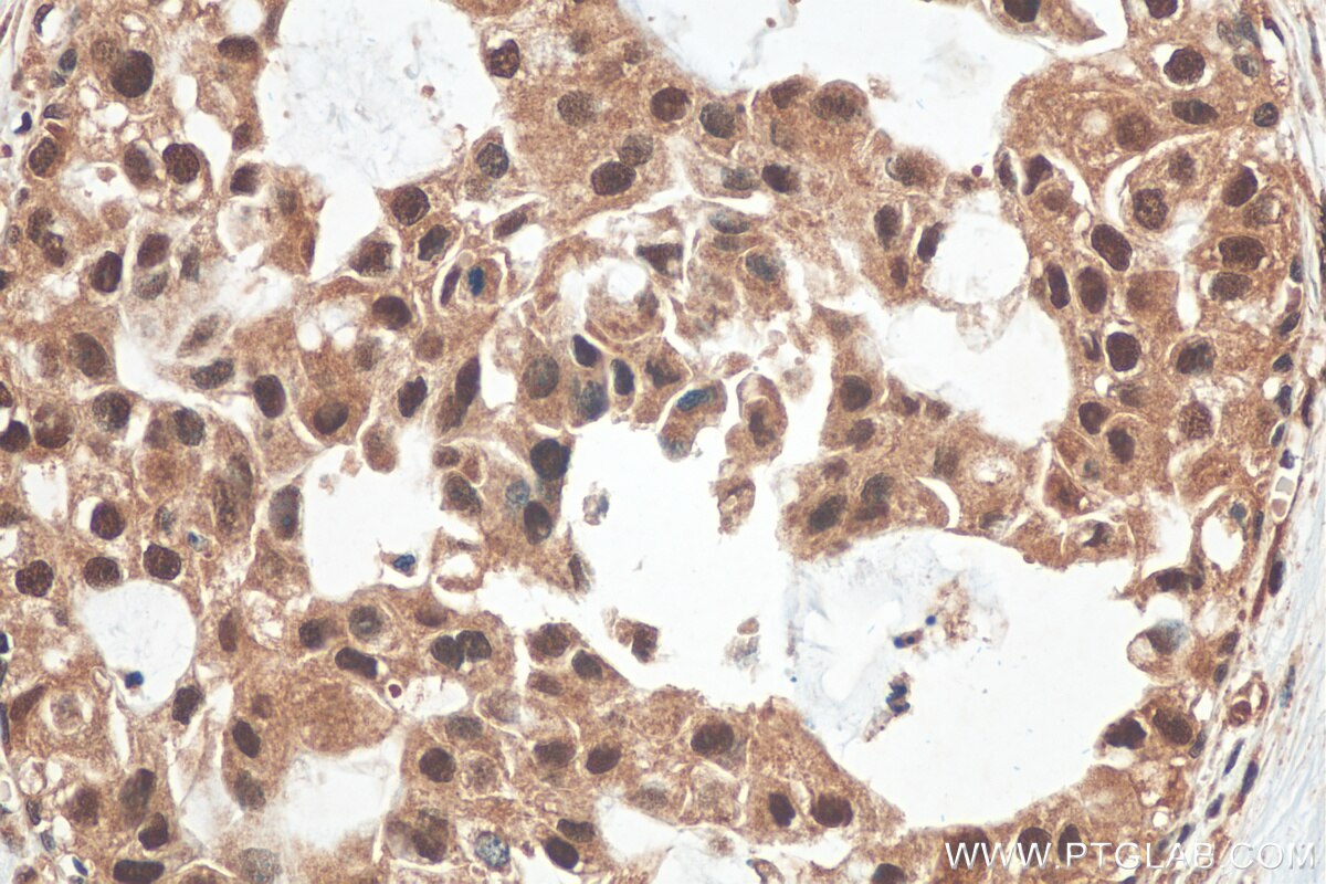 Immunohistochemistry (IHC) staining of human breast cancer tissue using PSMD3 Polyclonal antibody (12054-1-AP)