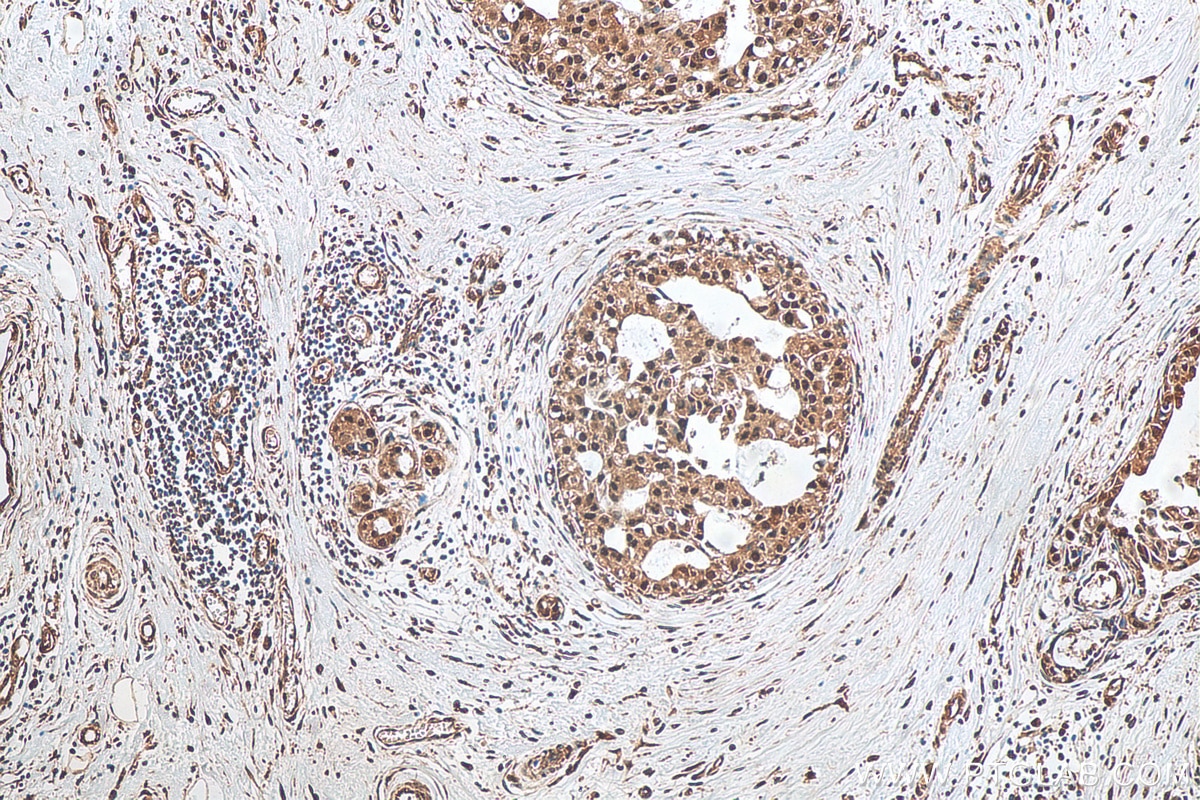Immunohistochemistry (IHC) staining of human breast cancer tissue using PSMD3 Polyclonal antibody (12054-1-AP)