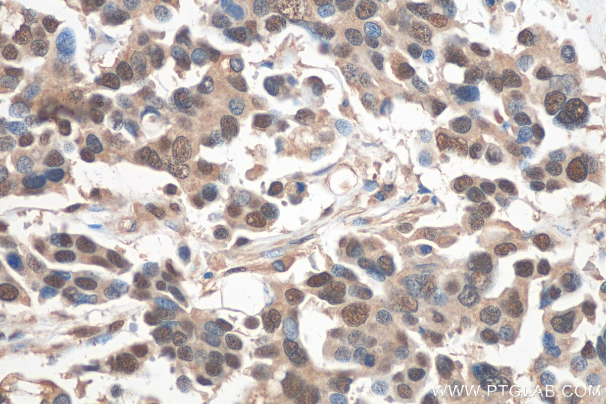 Immunohistochemistry (IHC) staining of human colon cancer tissue using PSMD3 Polyclonal antibody (12054-1-AP)