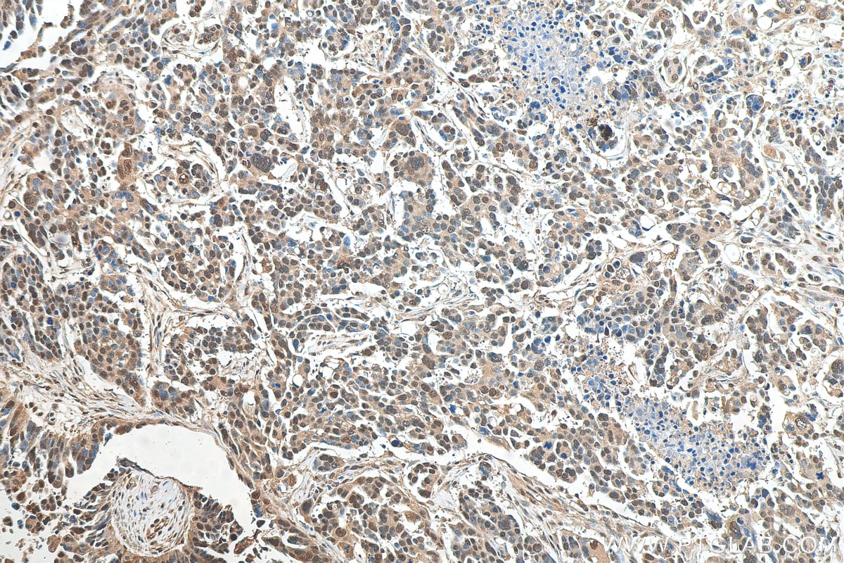 Immunohistochemistry (IHC) staining of human colon cancer tissue using PSMD3 Polyclonal antibody (12054-1-AP)