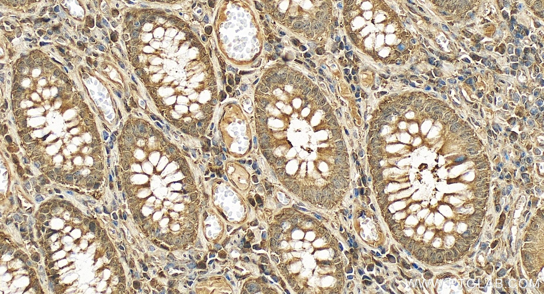 Immunohistochemistry (IHC) staining of human colon cancer tissue using PSMD3 Recombinant antibody (84928-2-RR)