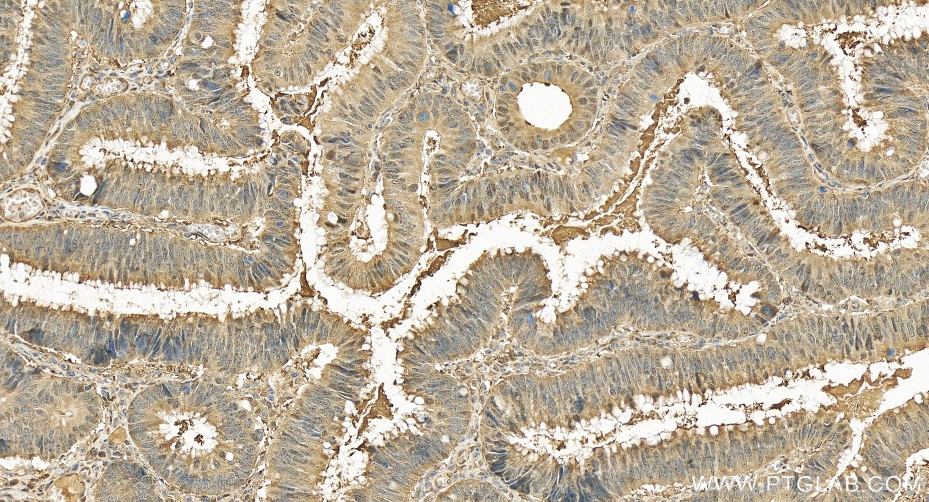 Immunohistochemistry (IHC) staining of human colon cancer tissue using PSMD3 Recombinant antibody (84928-2-RR)