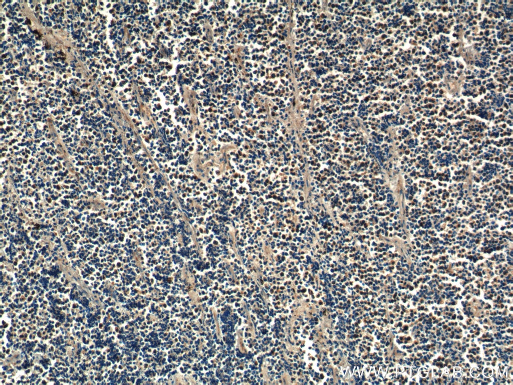 Immunohistochemistry (IHC) staining of human lung cancer tissue using PSMD4 Polyclonal antibody (14899-1-AP)