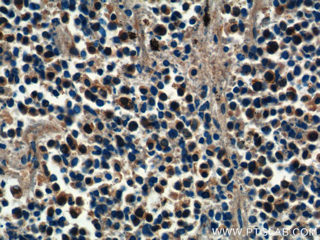 Immunohistochemistry (IHC) staining of human lung cancer tissue using PSMD4 Polyclonal antibody (14899-1-AP)