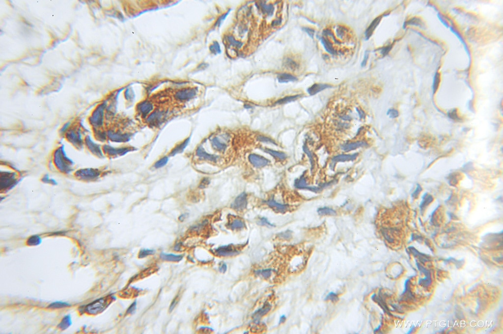 Immunohistochemistry (IHC) staining of human prostate cancer tissue using PSMD5 Polyclonal antibody (11469-1-AP)