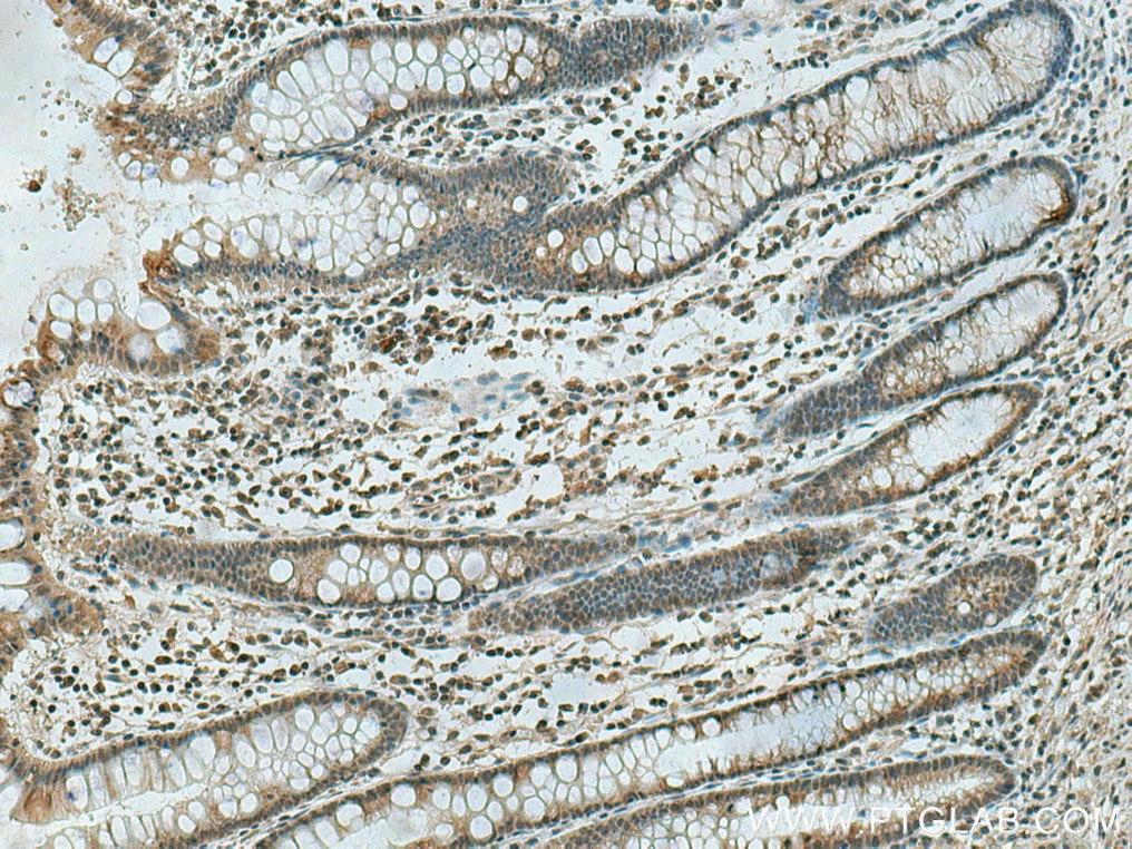 Immunohistochemistry (IHC) staining of human colon cancer tissue using PSMD5 Monoclonal antibody (67682-1-Ig)