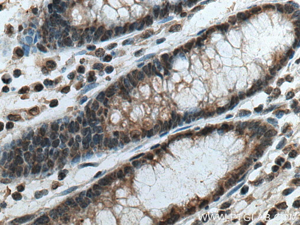 IHC staining of human colon cancer using 67682-1-Ig