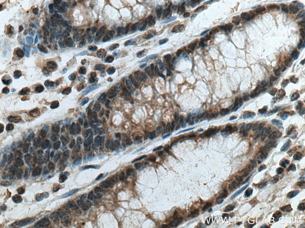 Immunohistochemistry (IHC) staining of human colon cancer tissue using PSMD5 Monoclonal antibody (67682-1-Ig)