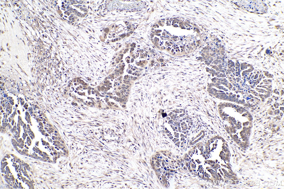 Immunohistochemistry (IHC) staining of human colon cancer tissue using PSMD7 Polyclonal antibody (16034-1-AP)