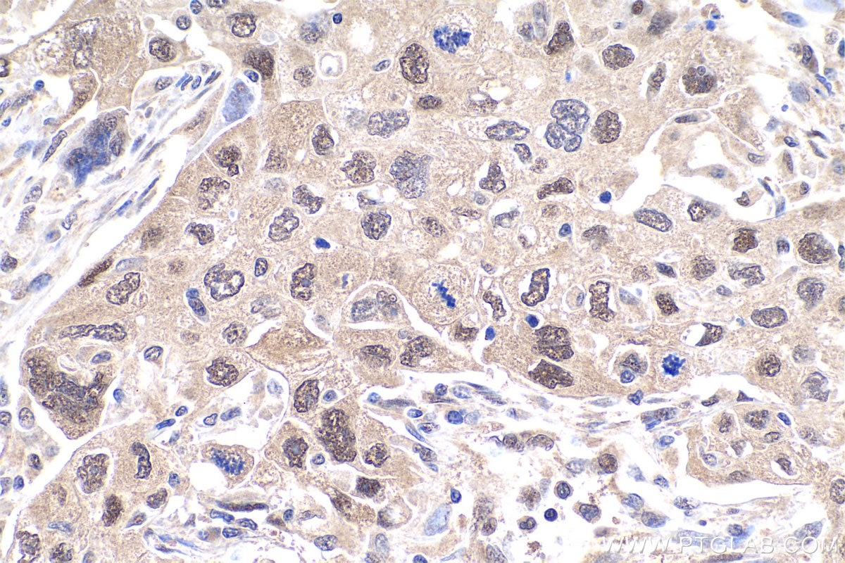 Immunohistochemistry (IHC) staining of human lung cancer tissue using PSMD7 Polyclonal antibody (16034-1-AP)