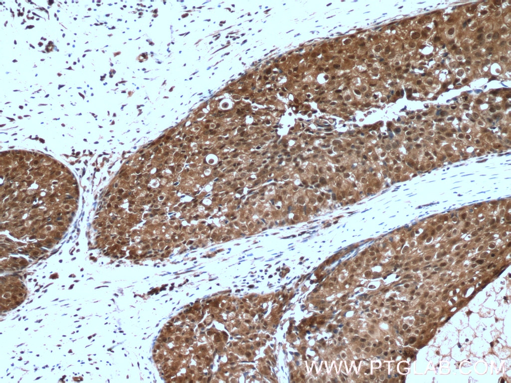 Immunohistochemistry (IHC) staining of human breast cancer tissue using PSMD9 Polyclonal antibody (26922-1-AP)