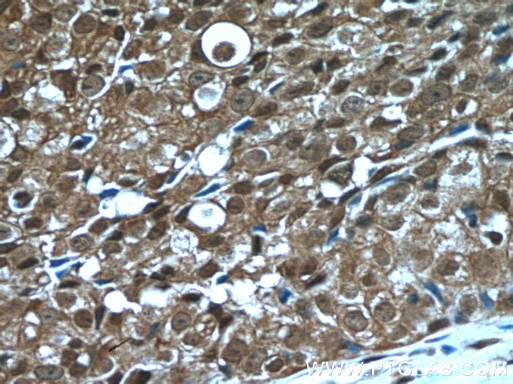 Immunohistochemistry (IHC) staining of human breast cancer tissue using PSMD9 Polyclonal antibody (26922-1-AP)