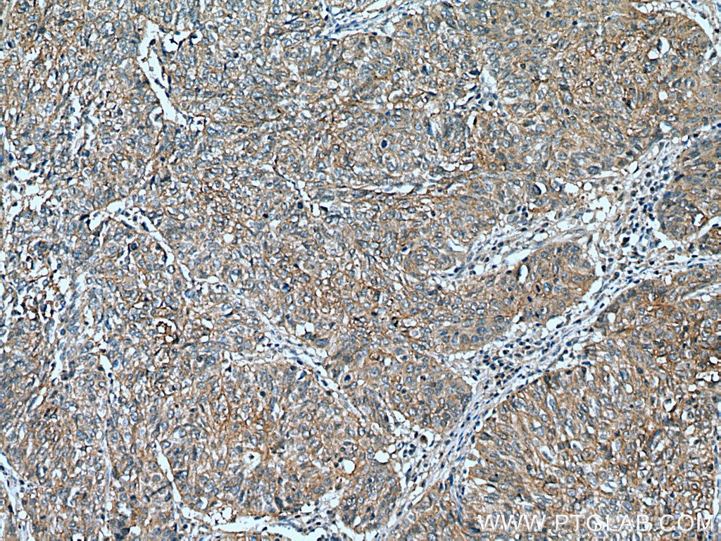 Immunohistochemistry (IHC) staining of human cervical cancer tissue using PSMD9 Monoclonal antibody (67338-1-Ig)