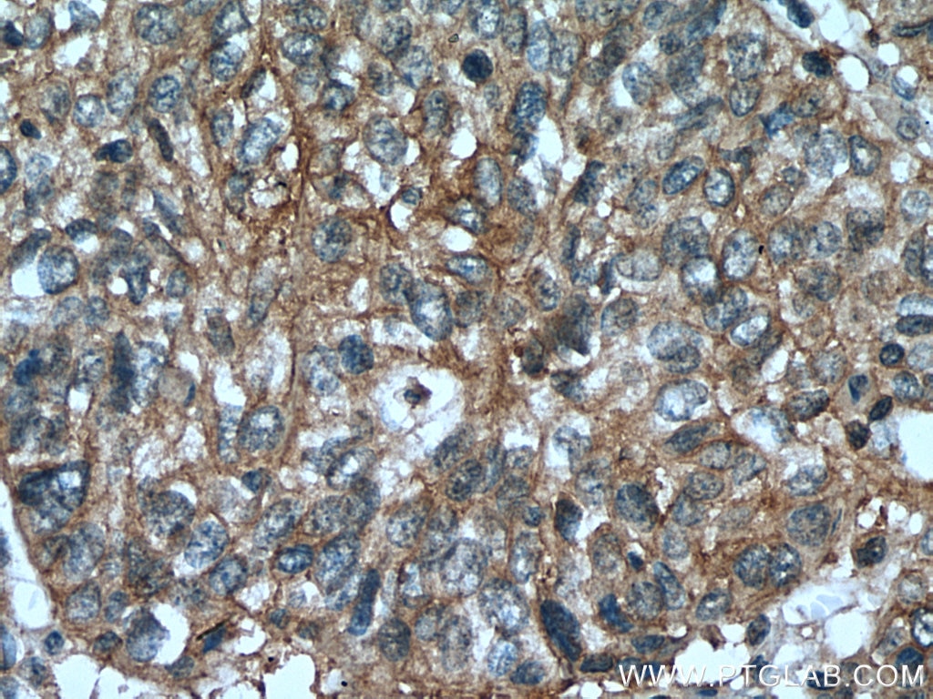 Immunohistochemistry (IHC) staining of human cervical cancer tissue using PSMD9 Monoclonal antibody (67338-1-Ig)