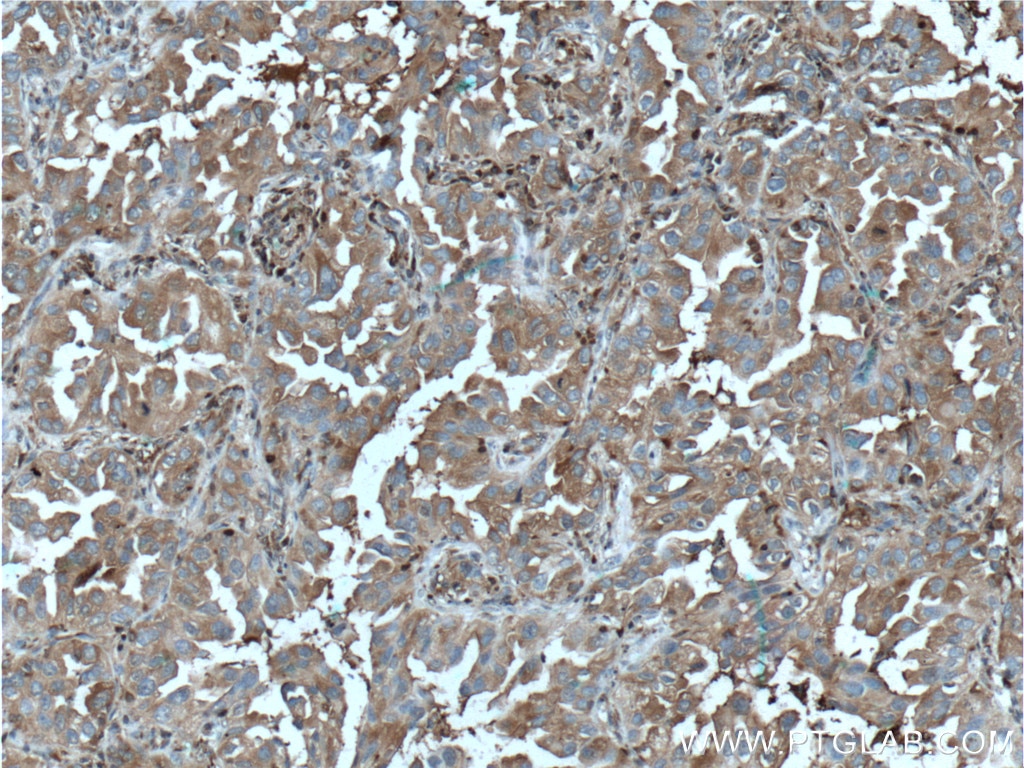 Immunohistochemistry (IHC) staining of human lung cancer tissue using PSME1 Polyclonal antibody (10543-1-AP)