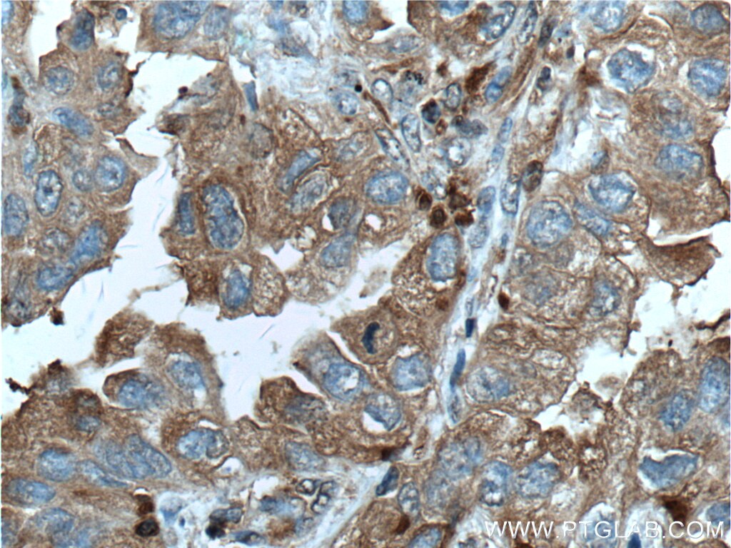 Immunohistochemistry (IHC) staining of human lung cancer tissue using PSME1 Polyclonal antibody (10543-1-AP)