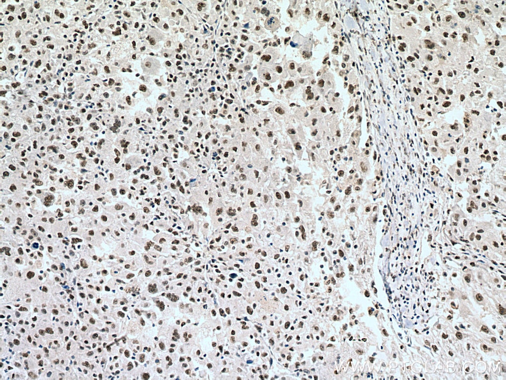 Immunohistochemistry (IHC) staining of human liver cancer tissue using PSME3 Monoclonal antibody (67629-1-Ig)