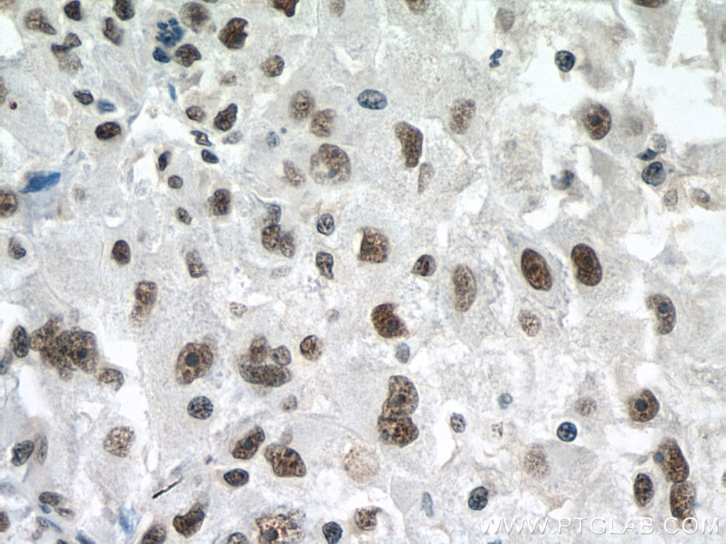 Immunohistochemistry (IHC) staining of human liver cancer tissue using PSME3 Monoclonal antibody (67629-1-Ig)