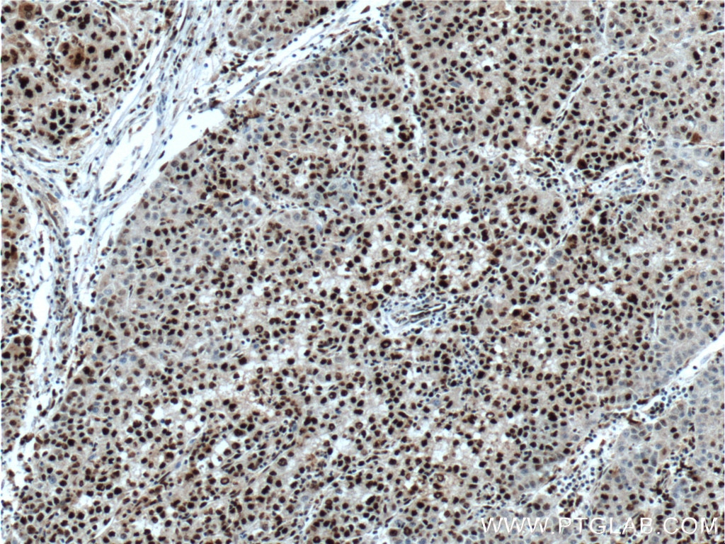 Immunohistochemistry (IHC) staining of human liver cancer tissue using PSME4 Polyclonal antibody (18799-1-AP)