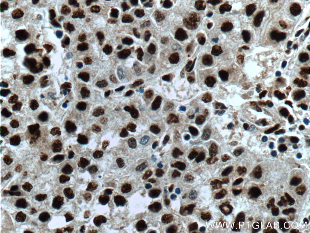 Immunohistochemistry (IHC) staining of human liver cancer tissue using PSME4 Polyclonal antibody (18799-1-AP)
