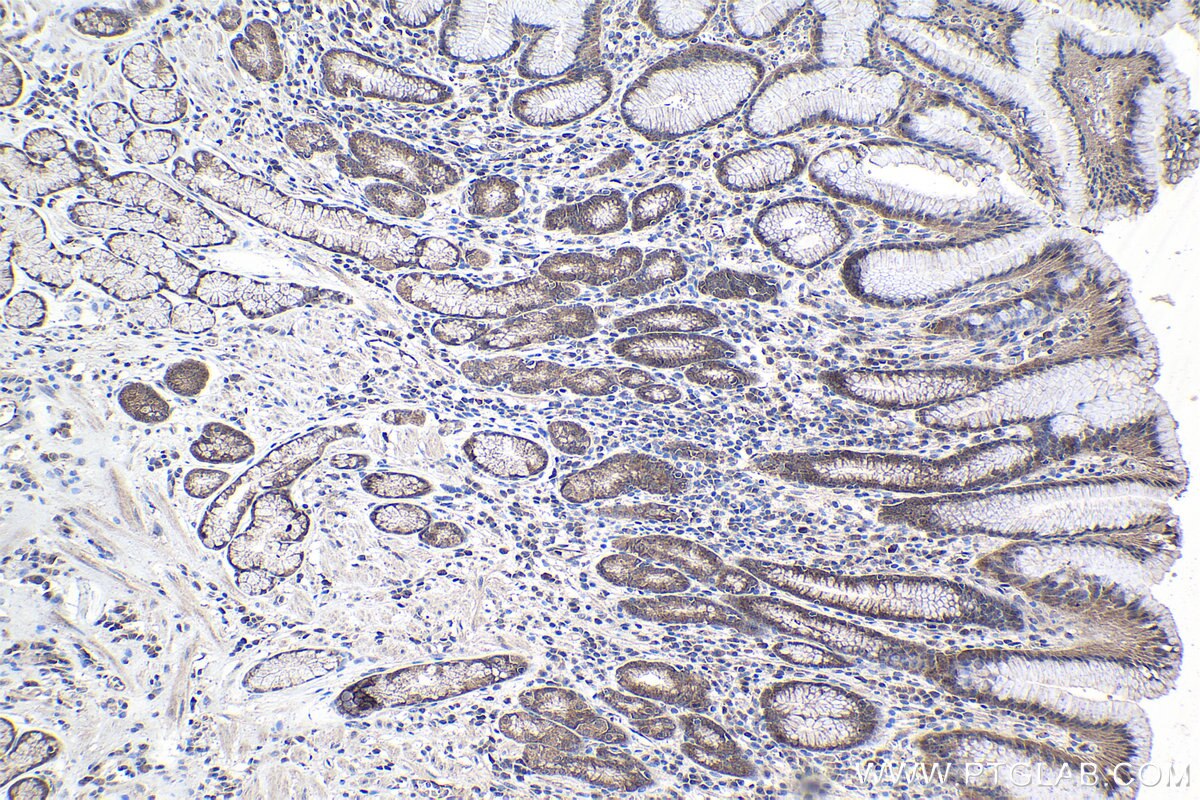 Immunohistochemistry (IHC) staining of human stomach cancer tissue using PSMG1 Polyclonal antibody (10335-1-AP)