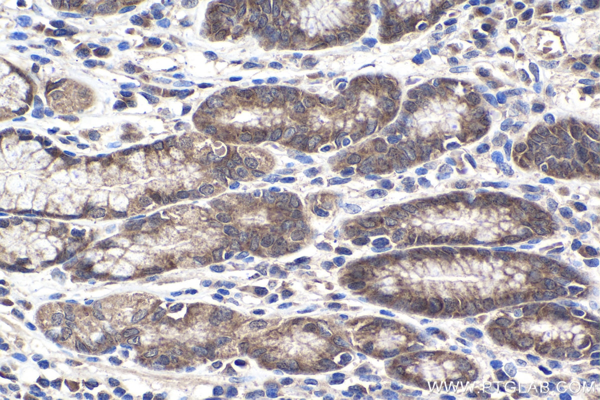 Immunohistochemistry (IHC) staining of human stomach cancer tissue using PSMG1 Polyclonal antibody (10335-1-AP)