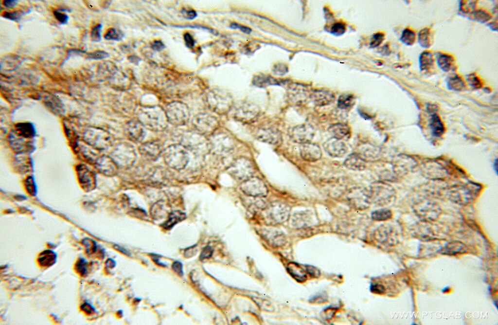 Immunohistochemistry (IHC) staining of human prostate cancer tissue using PSMG2 Polyclonal antibody (10959-1-AP)