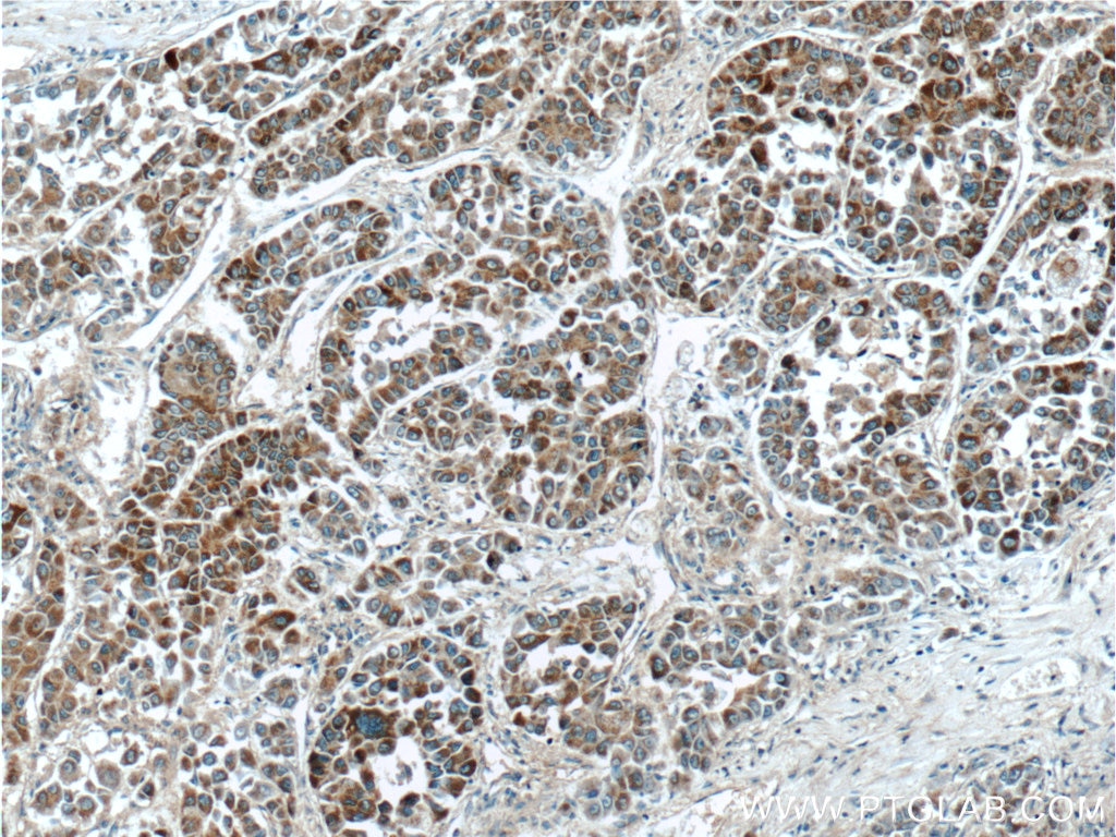 Immunohistochemistry (IHC) staining of human liver cancer tissue using PSMG3 Polyclonal antibody (15601-1-AP)