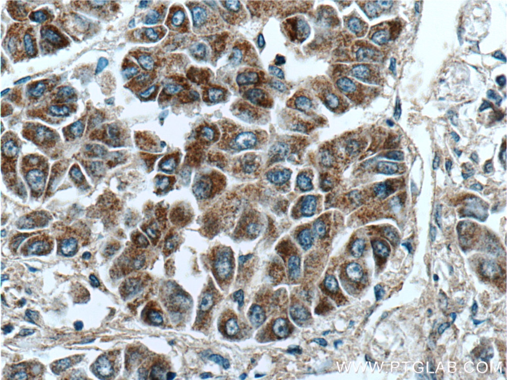 Immunohistochemistry (IHC) staining of human liver cancer tissue using PSMG3 Polyclonal antibody (15601-1-AP)