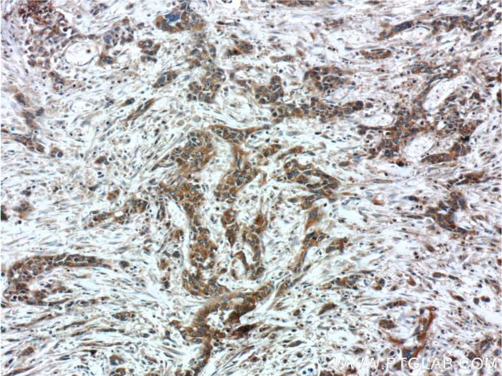 Immunohistochemistry (IHC) staining of human stomach cancer tissue using PSMG3 Polyclonal antibody (15601-1-AP)