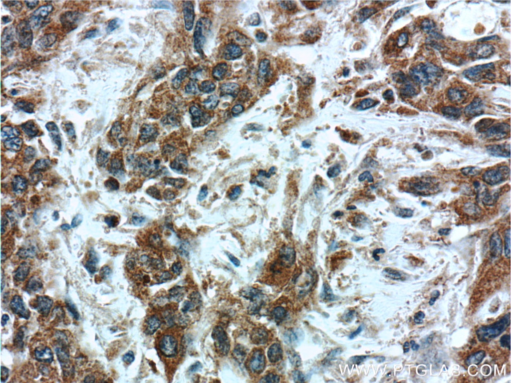 Immunohistochemistry (IHC) staining of human stomach cancer tissue using PSMG3 Polyclonal antibody (15601-1-AP)