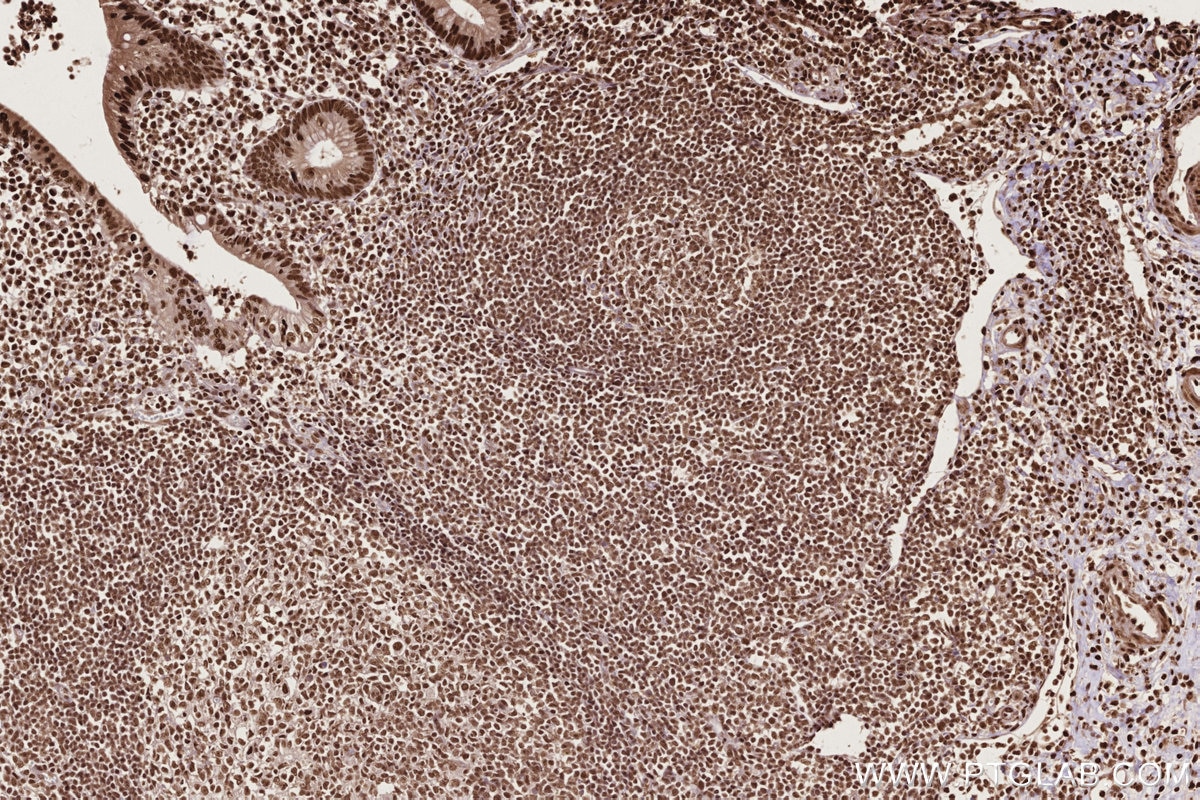 Immunohistochemistry (IHC) staining of human appendicitis tissue using PSPC1 Polyclonal antibody (16714-1-AP)