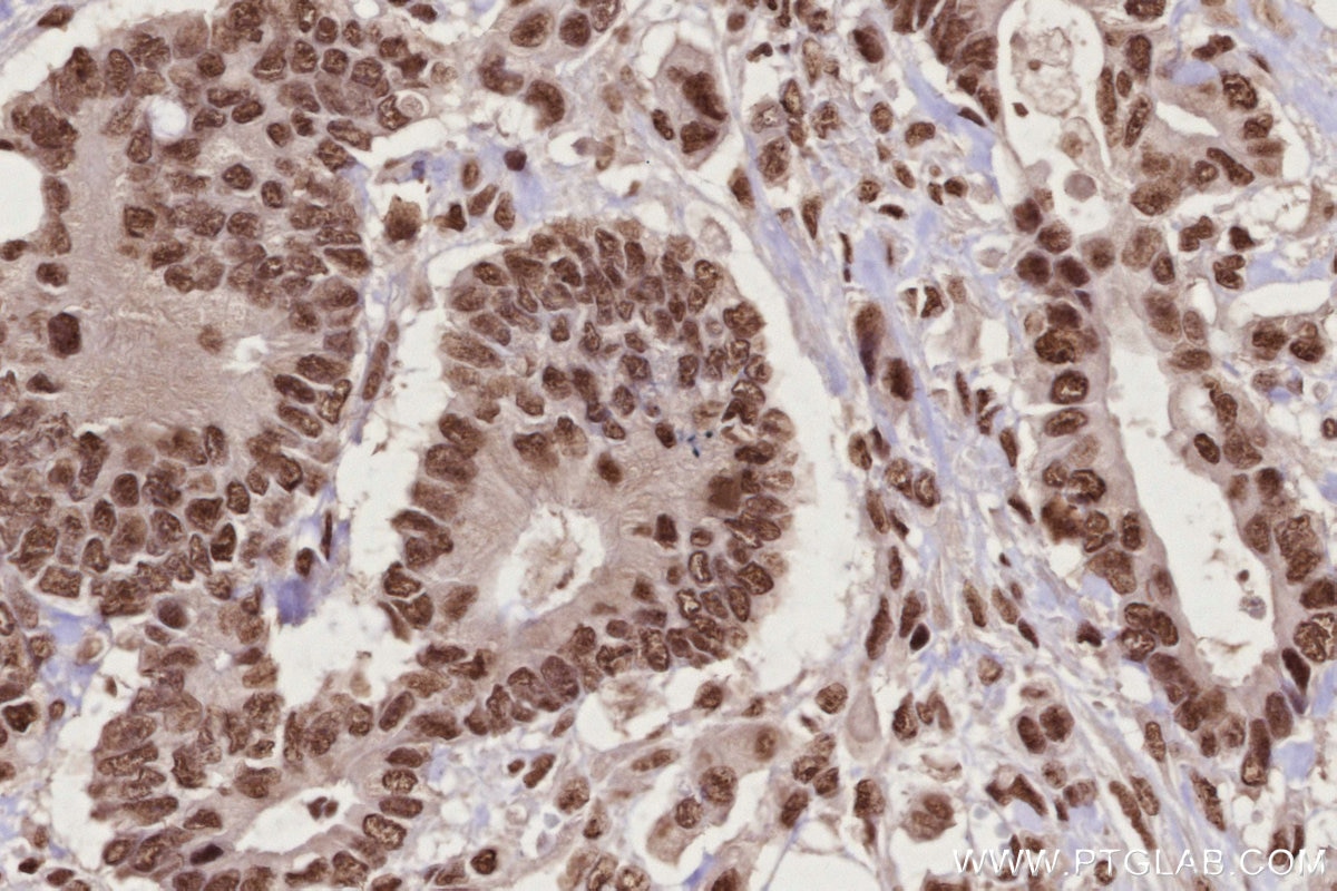 Immunohistochemistry (IHC) staining of human rectal cancer tissue using PSPC1 Polyclonal antibody (16714-1-AP)